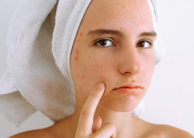 How to Combat Summer Acne: Skincare Strategies and Formulation Guide